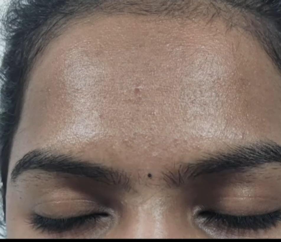 Skin Treatment After